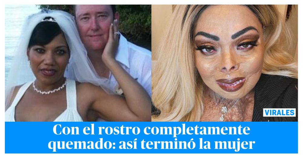 Mujer Termin Con El Rostro Desfigurado Luego De Que Su Marido Le